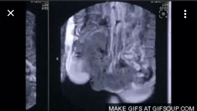 X-ray - blowjob